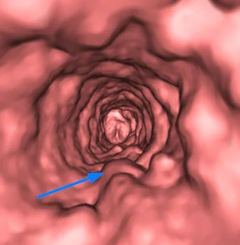 Three-dimensional CT rendering of an anonymized airway with tracheobronchial papillomatosis.